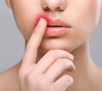 Aftercare For Lip Fillers 1