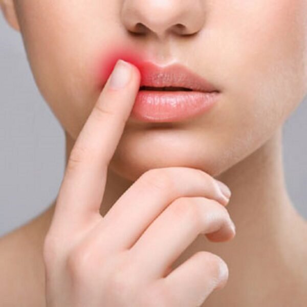 Aftercare For Lip Fillers 1