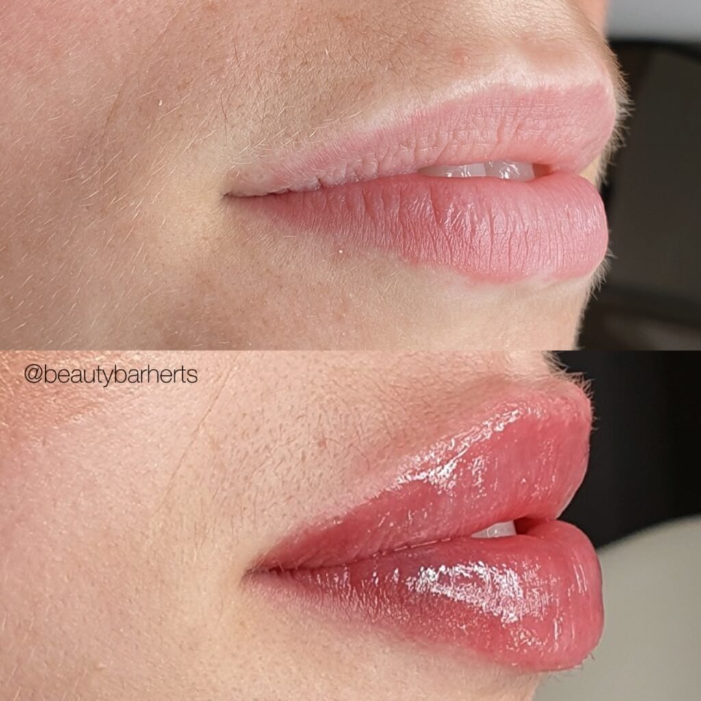 lip filler aftercare hertfordshire