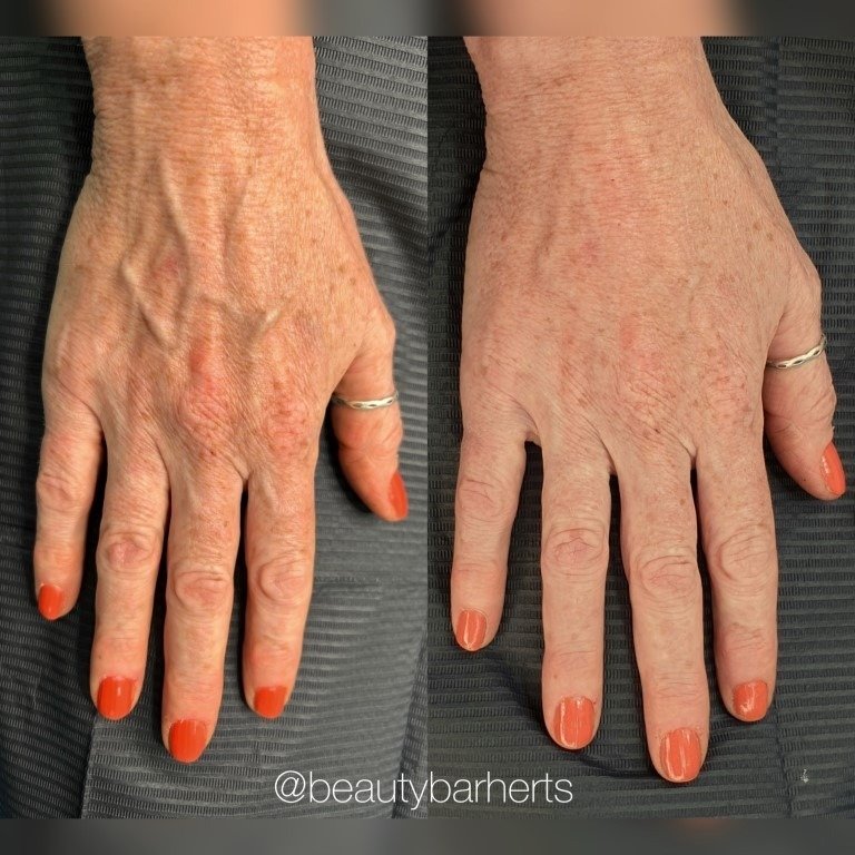 hand rejuvenation hatfield hertfordshire