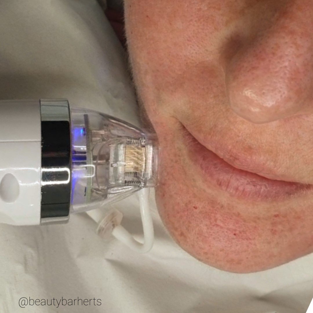 frax microneedling hertford hertfordshire