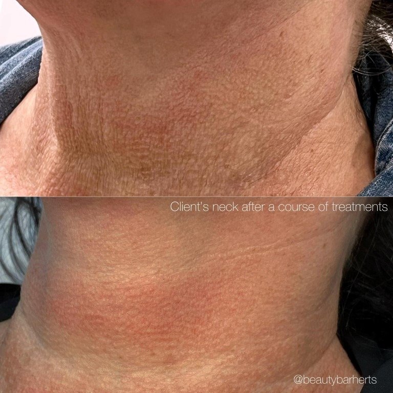 neck rejuvenation ware