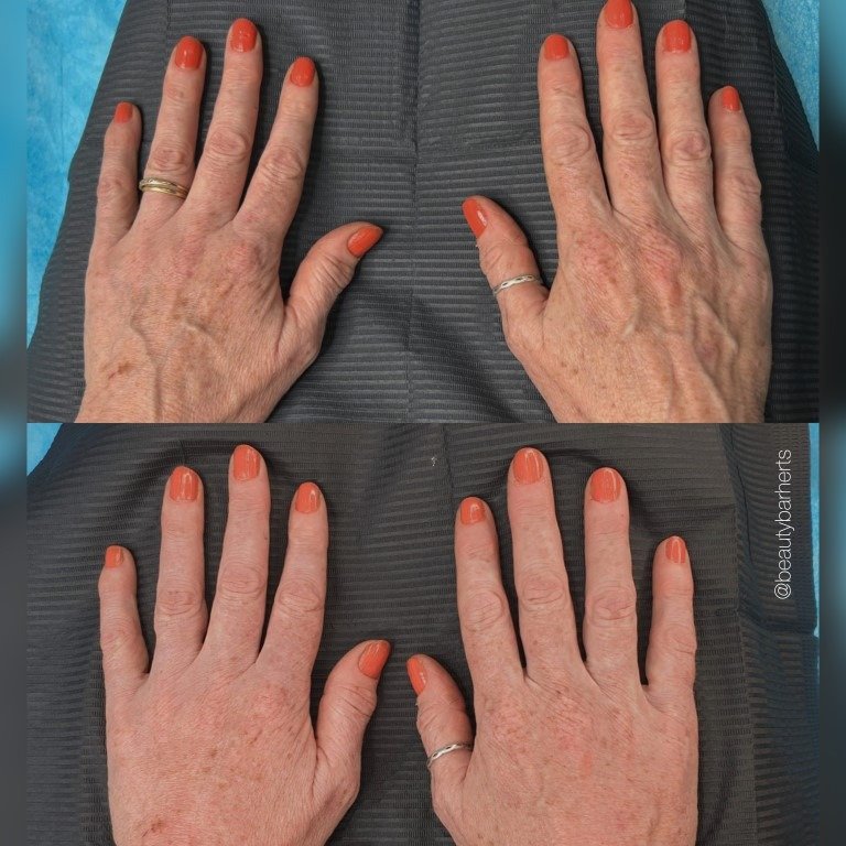 hand rejuvenation london