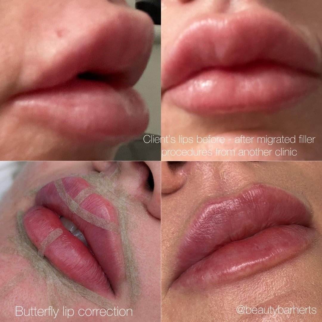 filler dissolving lips ware herts