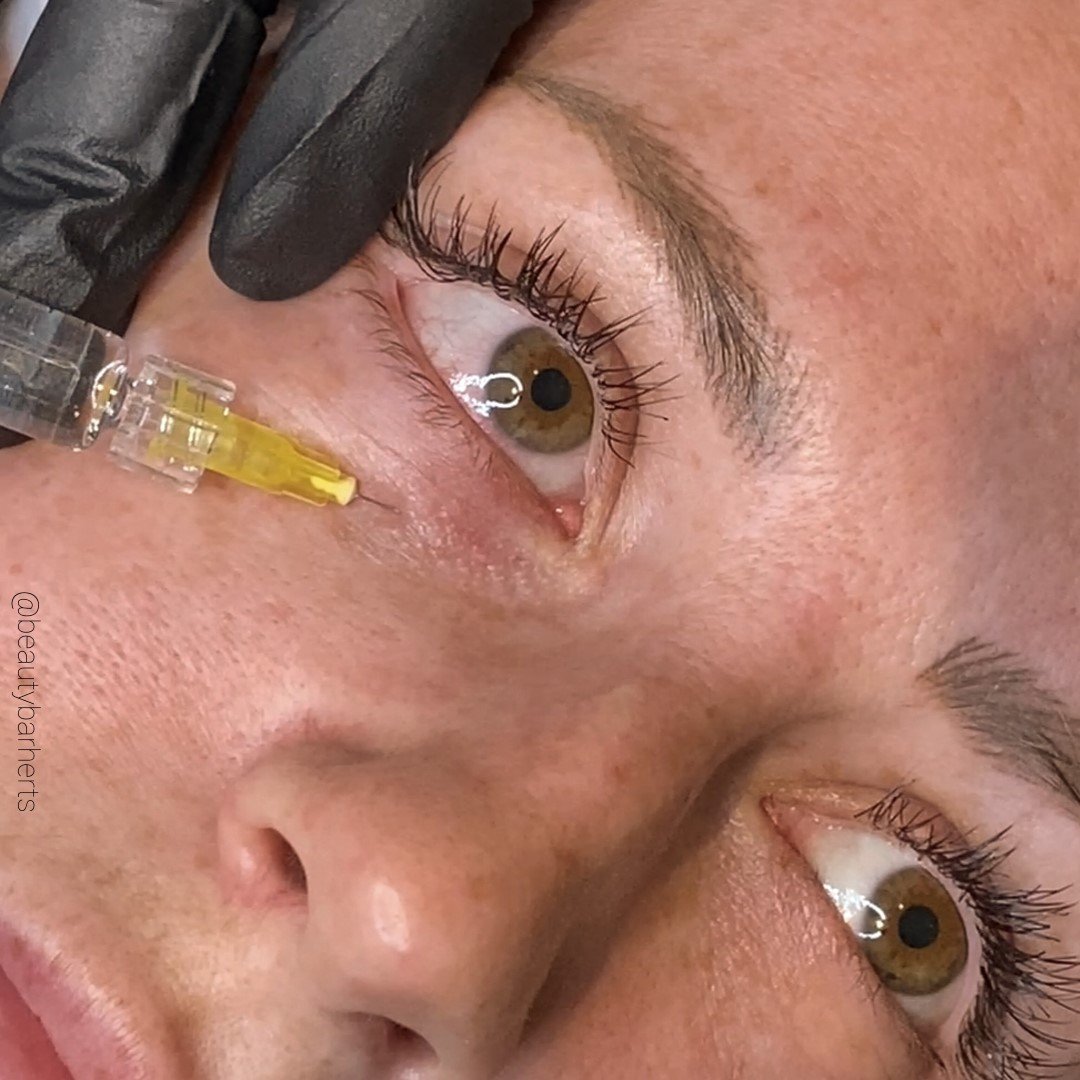 under eye mesotherapy hertford hertfordshire