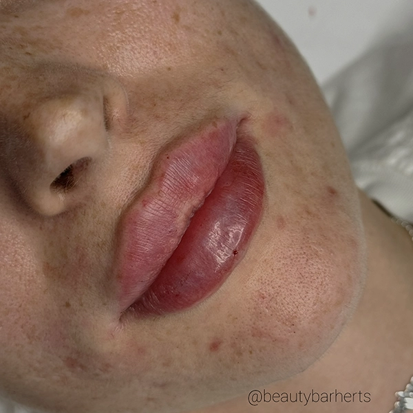 beautiful lip filler herts