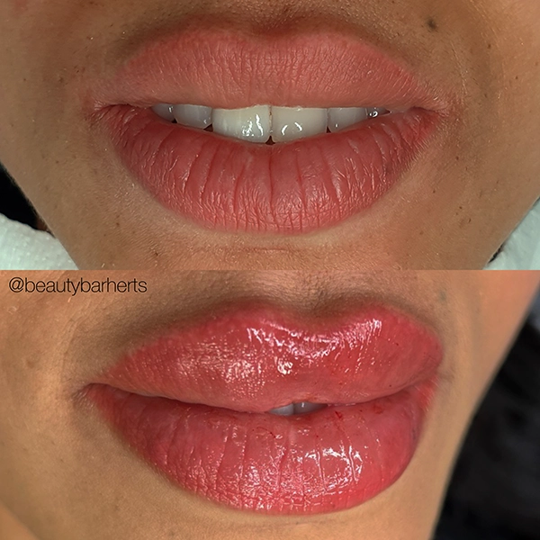 best lip filler hoddesdon