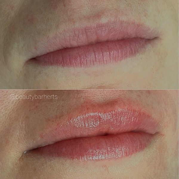 best natural lip filler clinic