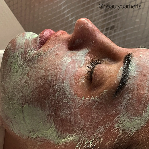 chemical peel skin acne