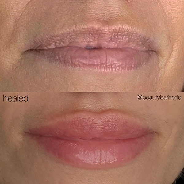 hertfordshire lip filler beauty bar