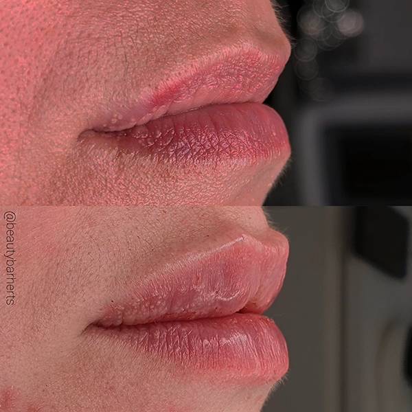 lip filler before after potters bar