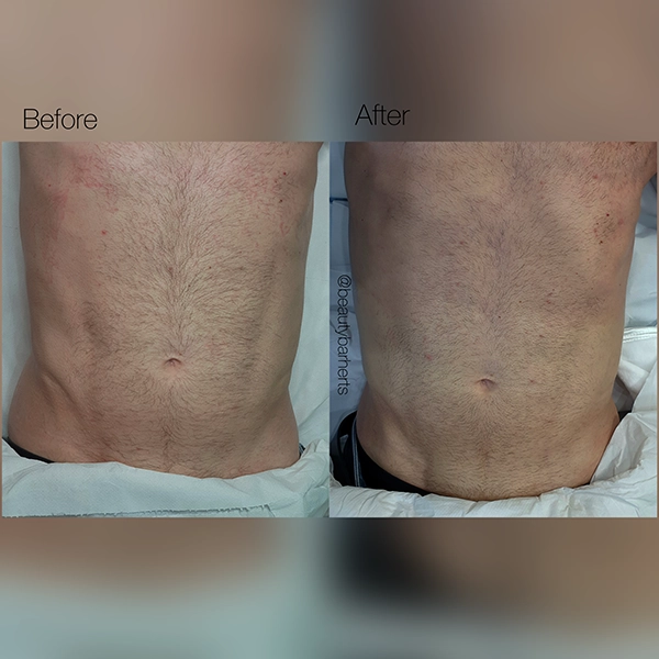 male stomach tightening hertfordshire