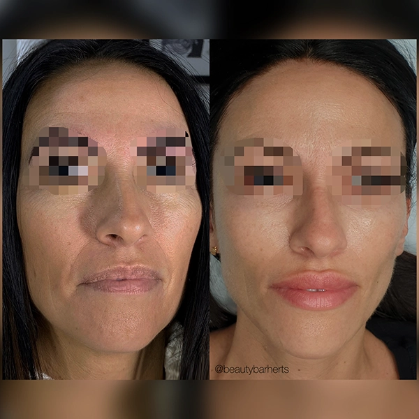 rf microneedling hertfordshire before after