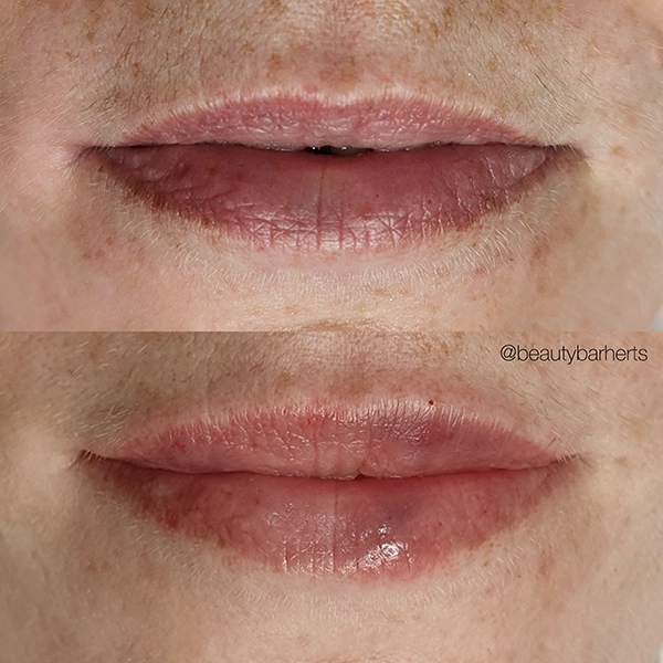 small lips filler sawbridgeworth