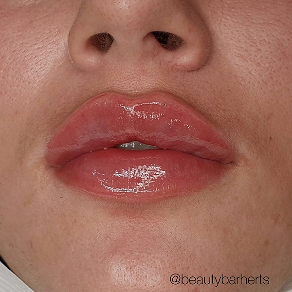 ware lip fillers