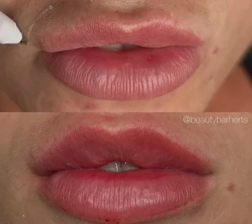 ml lip filler hertfordshire