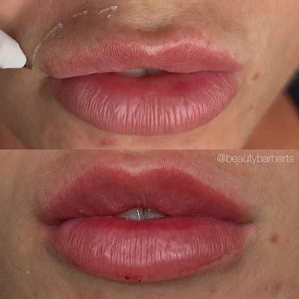 ml lip filler hertfordshire