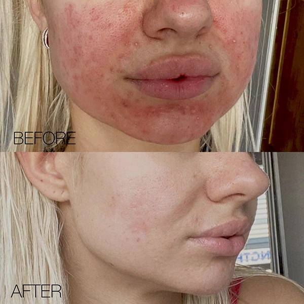 acne hormonal hertfordshire treatment