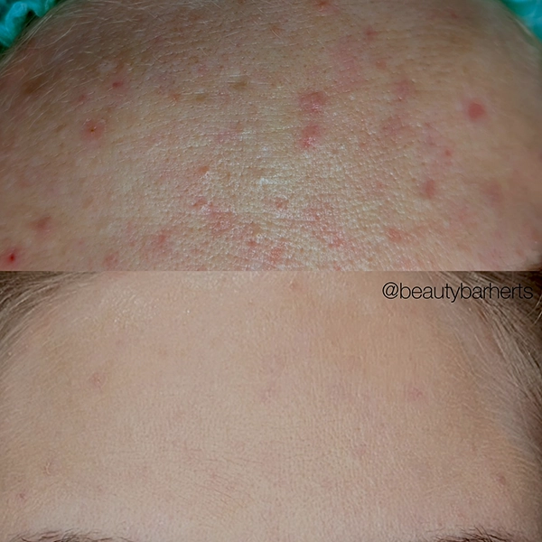 acne hormonal hertfordshire