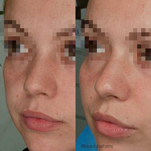 cheek filler hertford hertfordshire