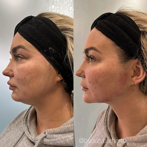 chin filler face shapeing epping