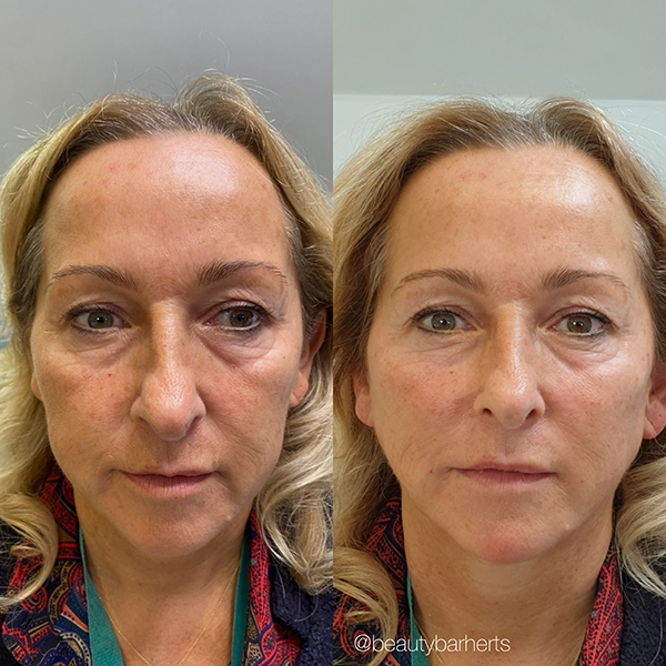 facial dermal filler hertfordshire