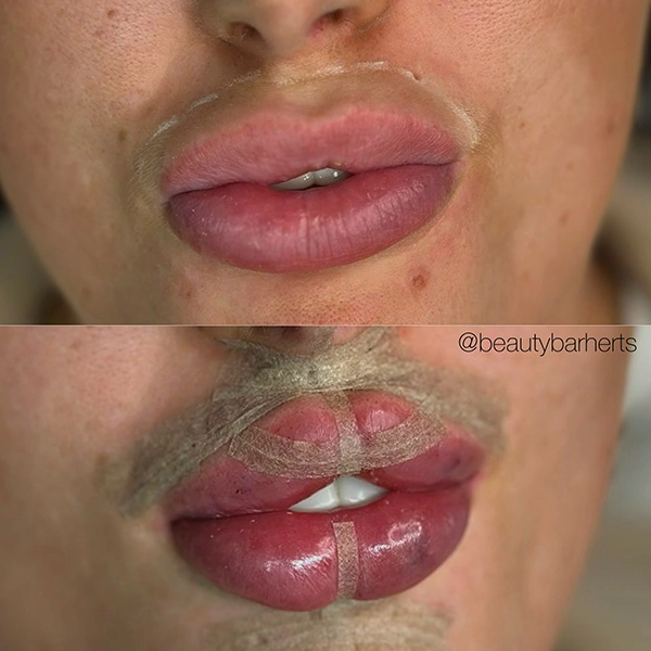 filler dissolving lip filler hertfordshire