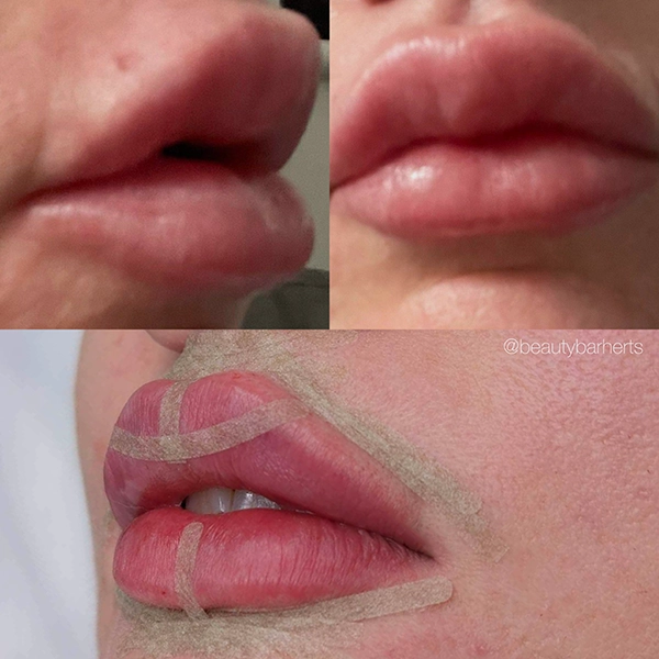 filler dissolving lips ware herts