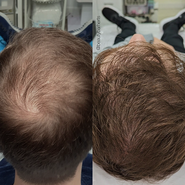 hair loss treatment ware hertfordshire