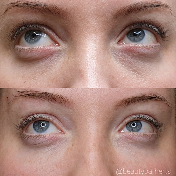 hitchin dermal filler under eye