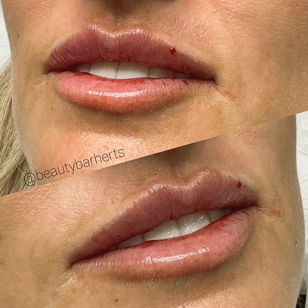 lip filler after dissolving hertfordshire