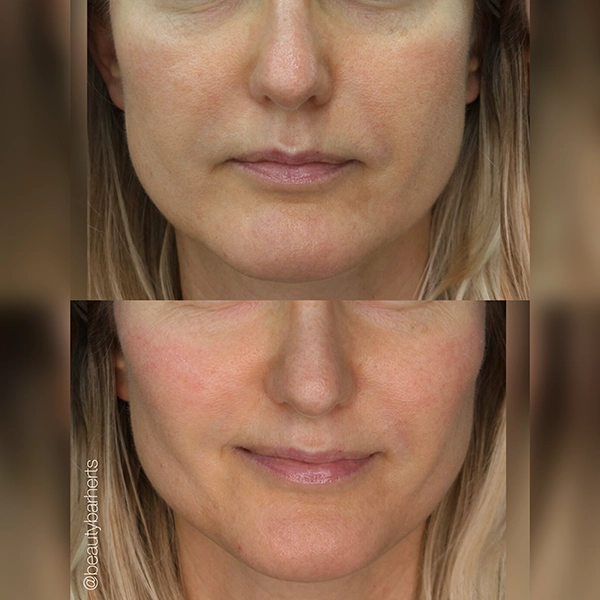 lower facelift no scalpel hertfordshire