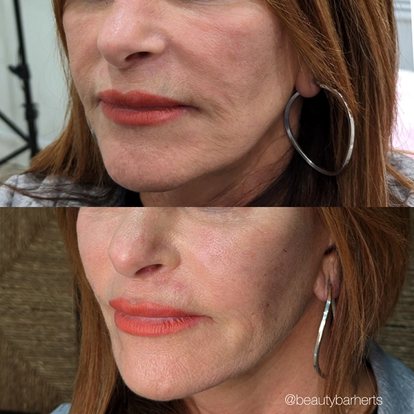 non surgical facelift ware hertfordshire