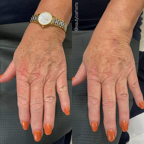 anti age hand treatment hertfordshire ware