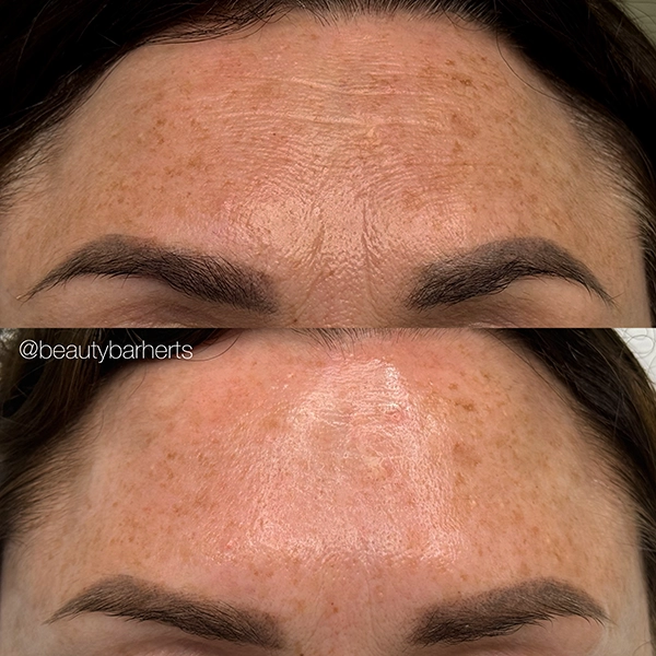 anti aging wrinkle treatment ware