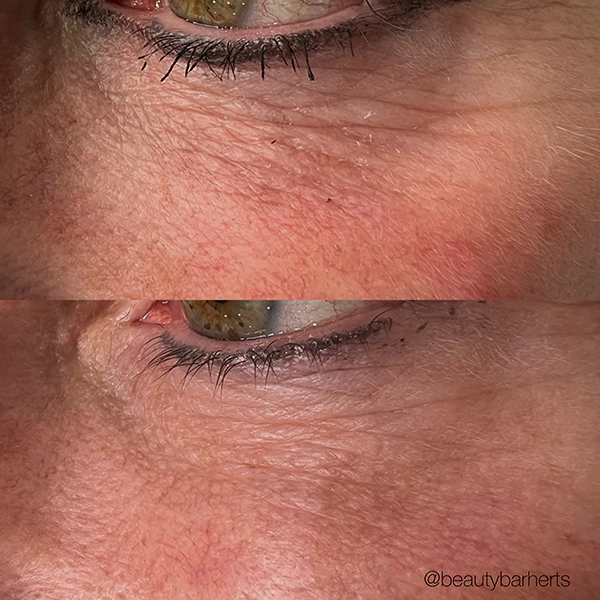 best under eye treatment epping