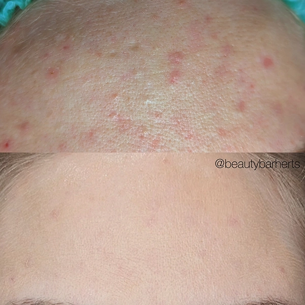 biorepeel treatment hertfordshire acne