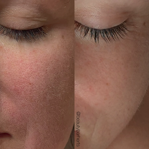 chemical peel clear skin hertfordshire