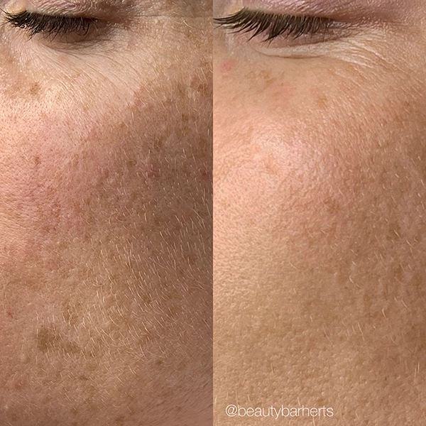 chemical peel pigmentation hertfordshire