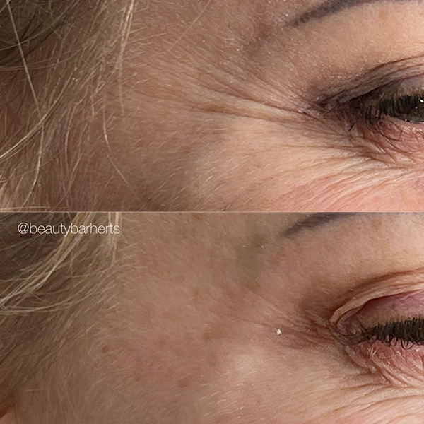 crows feet treatment hertfordshire