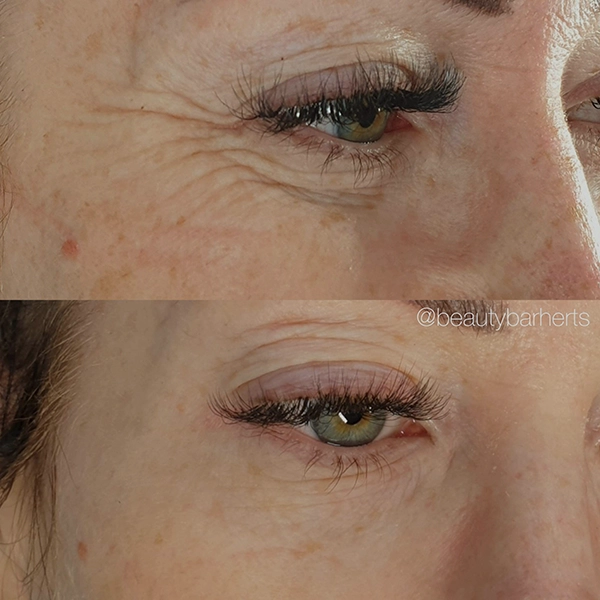 eye treatments wrinkles hertfordshire