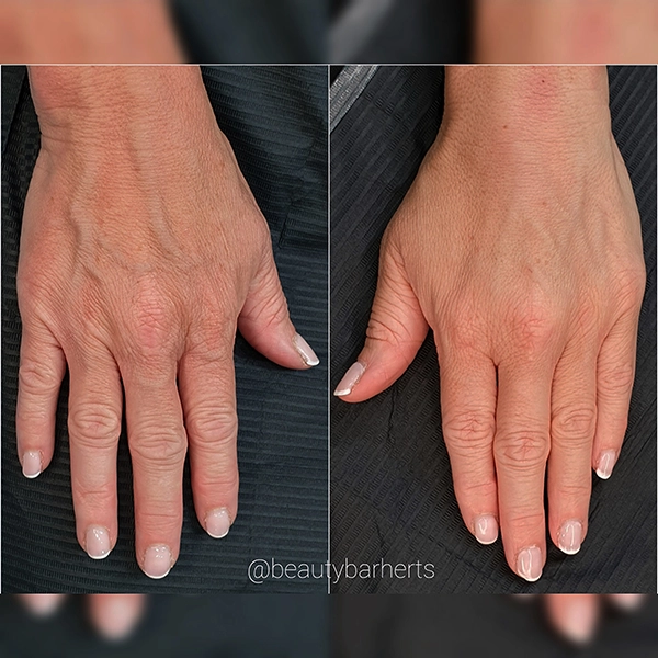 hand rejuvenation cheshunt hertfordshire