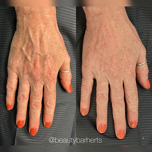 hand rejuvenation hatfield hertfordshire