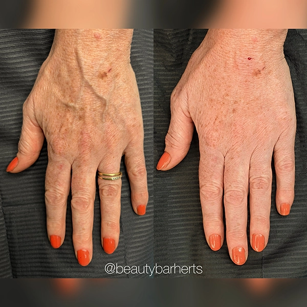 hand rejuvenation ware hertfordshire