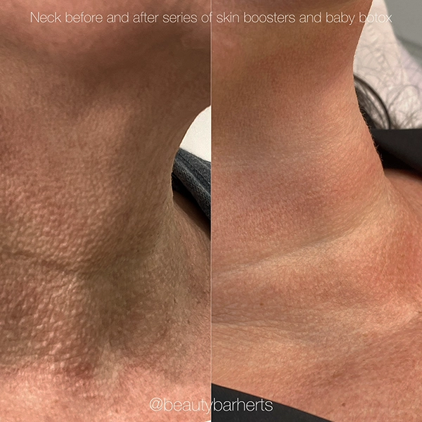 neck rejuvenation hertfordshire