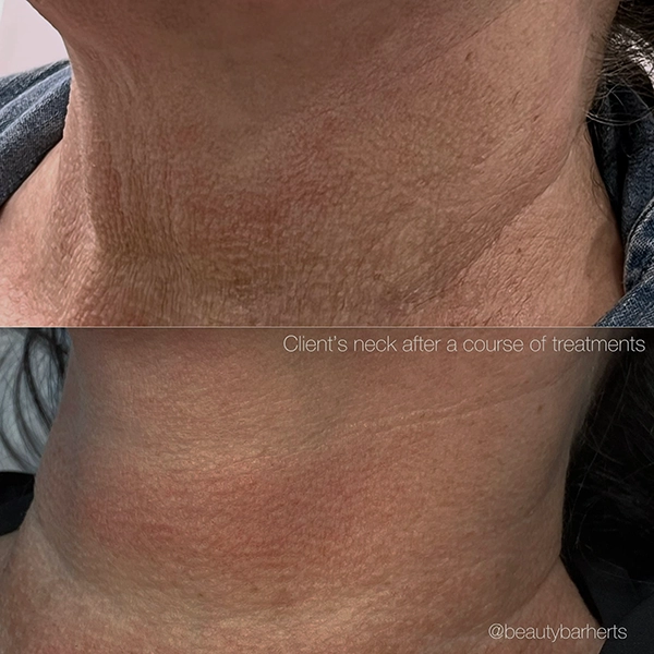 neck rejuvenation ware