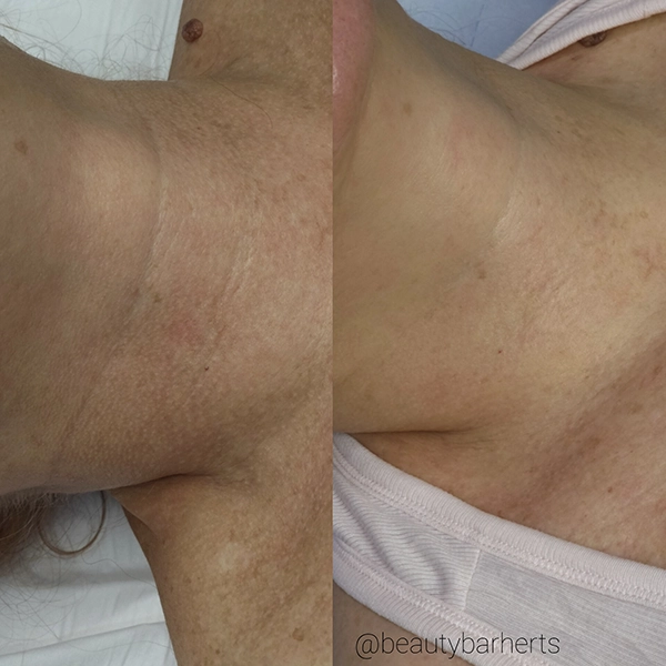 non surgical neck lift hertfordshire