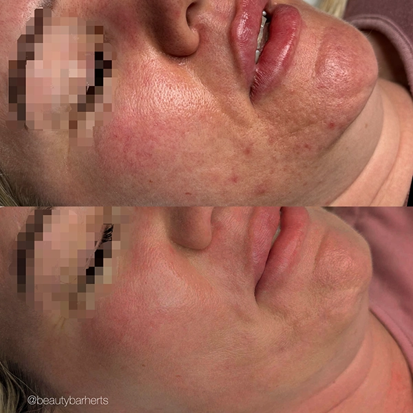 rosacea treatment hertfordshire ware