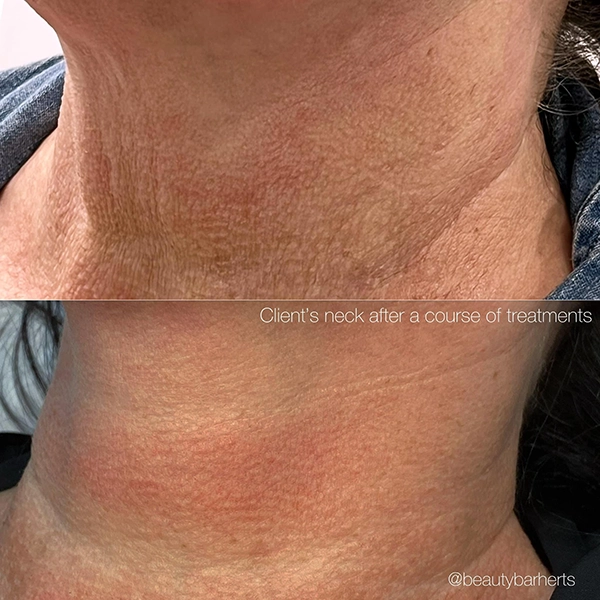 skin boosters for neck hertfordshire