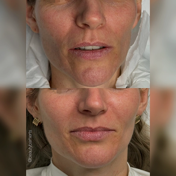 tkn skin rejuvenation ware hertfordshire